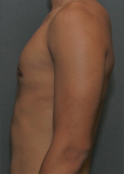 Gynecomastia Before & After Gallery - Patient 8284605 - Image 8