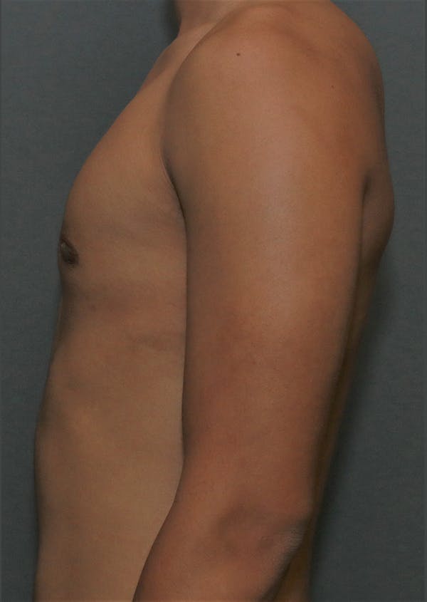 Gynecomastia Before & After Gallery - Patient 8284605 - Image 8