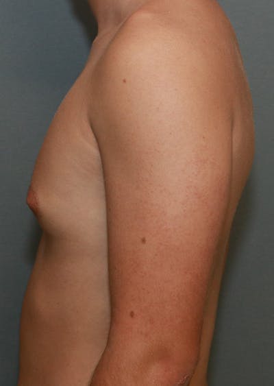Gynecomastia Before & After Gallery - Patient 7329084 - Image 14