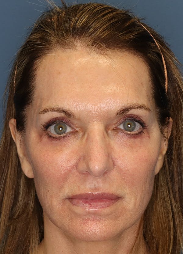 Facelift Before & After Gallery - Patient 7369036 - Image 2