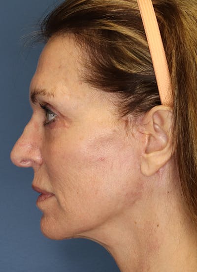 Facelift Before & After Gallery - Patient 7369036 - Image 6