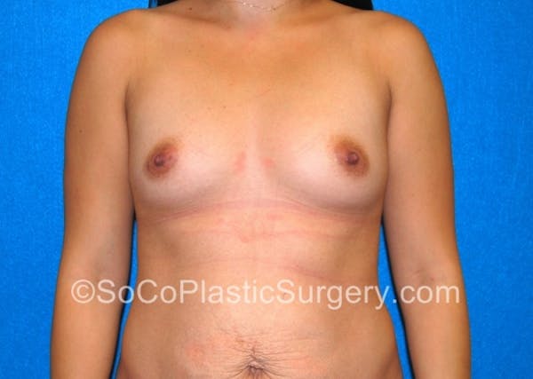 Breast Augmentation Before & After Gallery - Patient 7809517 - Image 1