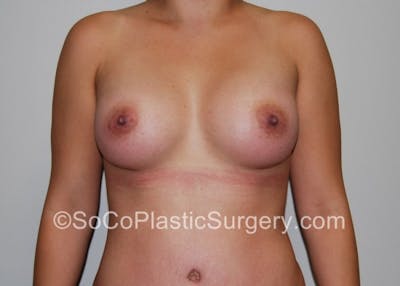 Breast Augmentation Before & After Gallery - Patient 7809517 - Image 2