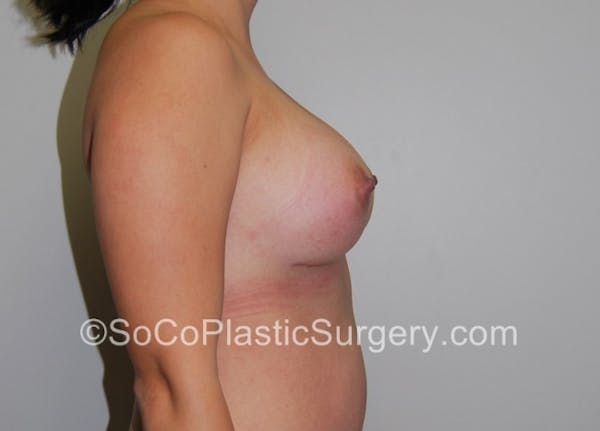Breast Augmentation Before & After Gallery - Patient 7809517 - Image 6