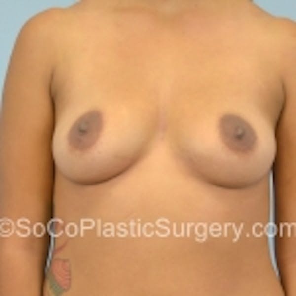 Breast Augmentation Before & After Gallery - Patient 7809553 - Image 1
