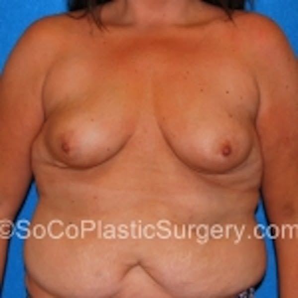 Breast Augmentation Before & After Gallery - Patient 7809555 - Image 1