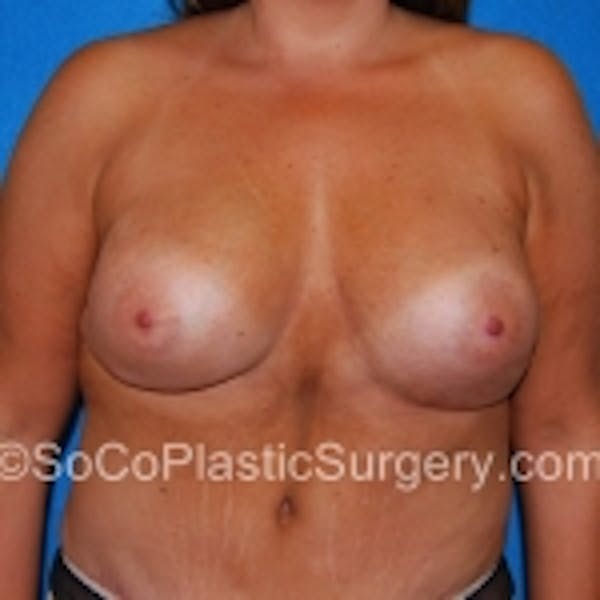 Breast Augmentation Before & After Gallery - Patient 7809555 - Image 2