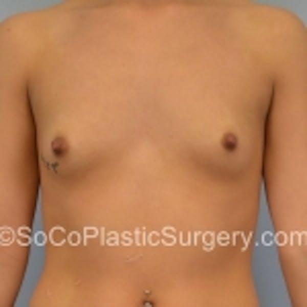 Breast Augmentation Before & After Gallery - Patient 7809556 - Image 1