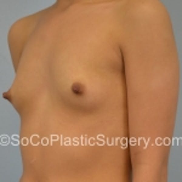 Breast Augmentation Before & After Gallery - Patient 7809556 - Image 3