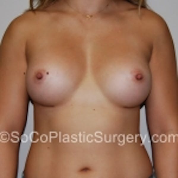 Breast Augmentation Before & After Gallery - Patient 7809557 - Image 2