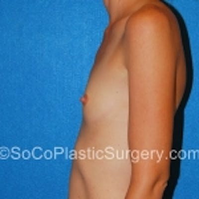 Breast Augmentation Before & After Gallery - Patient 7809558 - Image 1