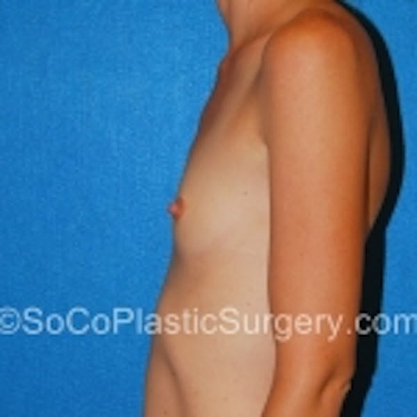Breast Augmentation Before & After Gallery - Patient 7809558 - Image 1