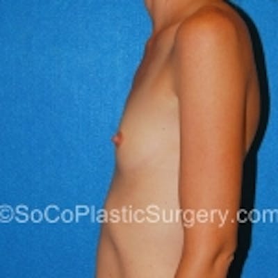 Breast Augmentation Gallery - Patient 7809558 - Image 1