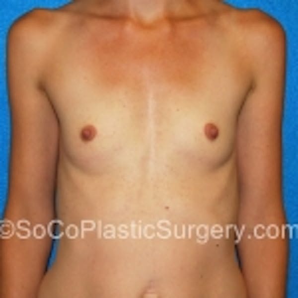 Breast Augmentation Before & After Gallery - Patient 7809558 - Image 3