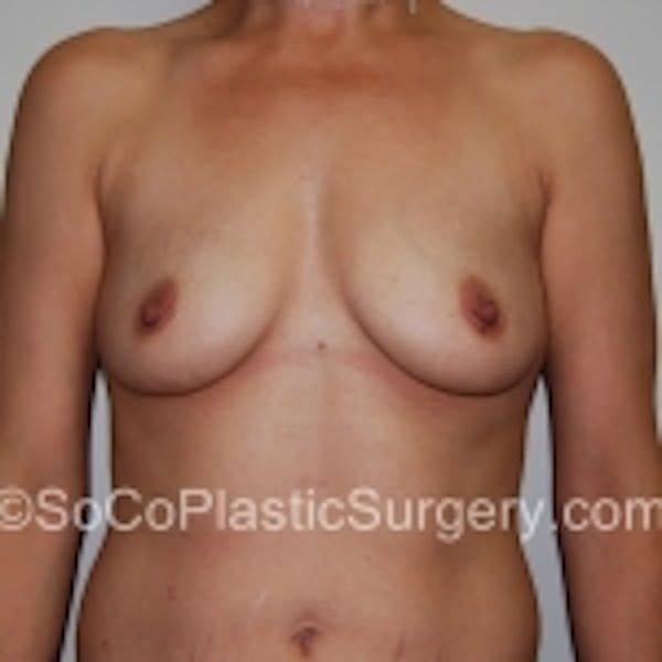 Breast Augmentation Before & After Gallery - Patient 7809564 - Image 1