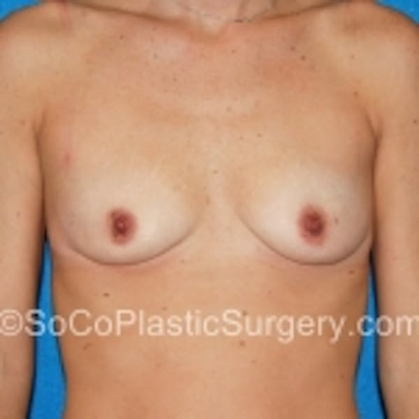 Breast Augmentation Before & After Gallery - Patient 7809569 - Image 1