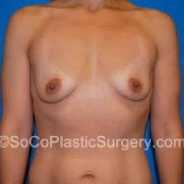 Breast Augmentation Before & After Gallery - Patient 7809574 - Image 1