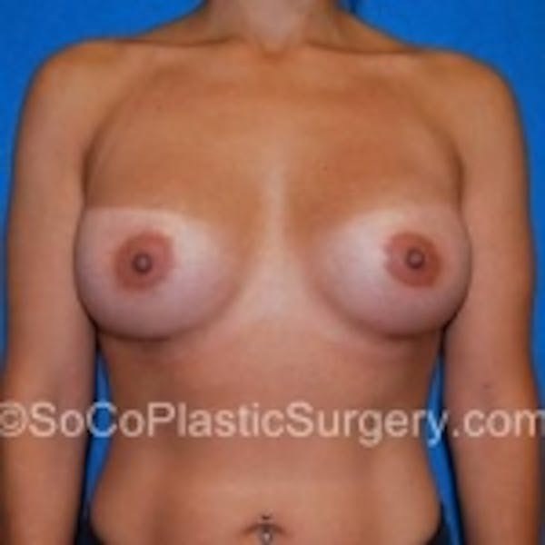 Breast Augmentation Before & After Gallery - Patient 7809574 - Image 2