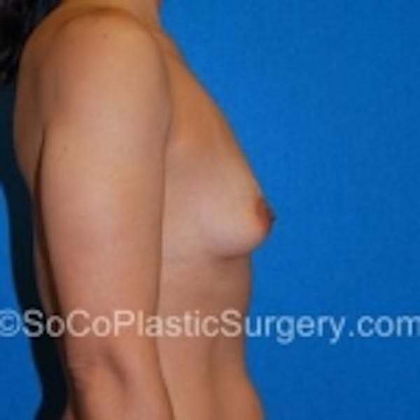 Breast Augmentation Before & After Gallery - Patient 7809574 - Image 3