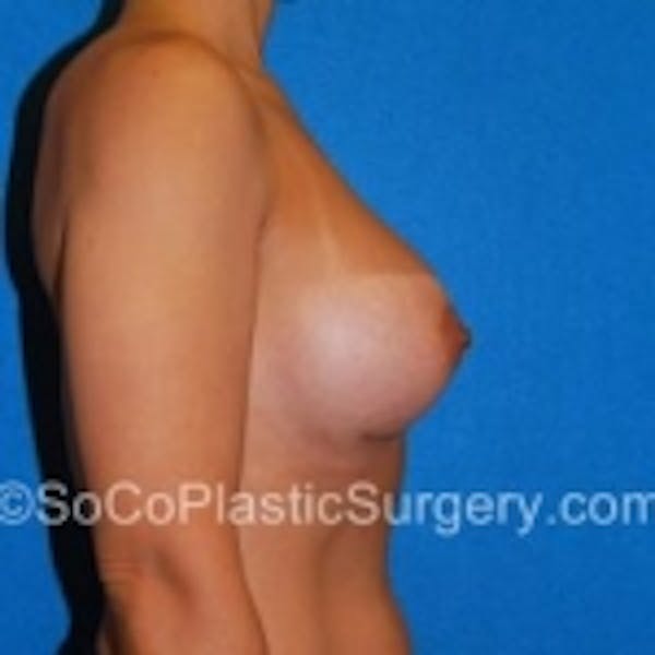 Breast Augmentation Before & After Gallery - Patient 7809574 - Image 4