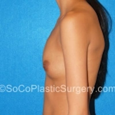 Breast Augmentation Before & After Gallery - Patient 7809575 - Image 1