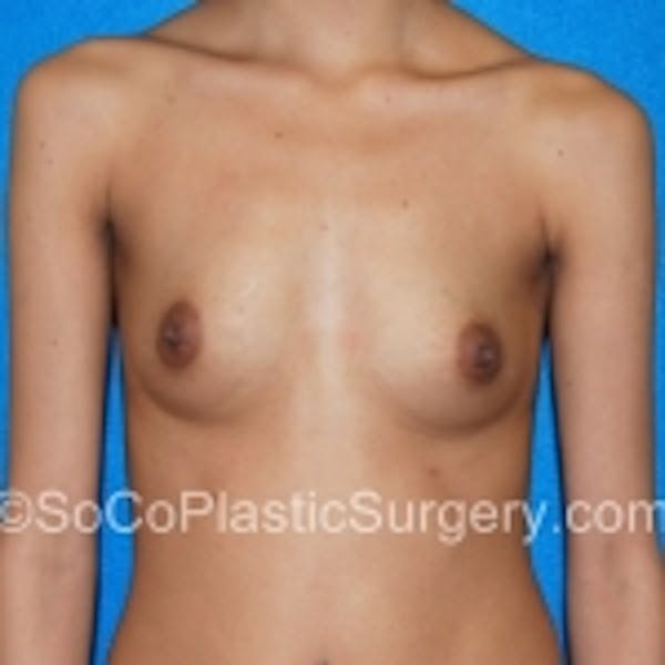 Breast Augmentation Before & After Gallery - Patient 7809575 - Image 3