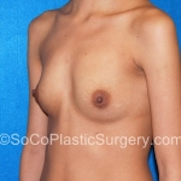 Breast Augmentation Before & After Gallery - Patient 7809575 - Image 5