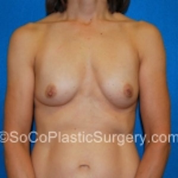 Breast Augmentation Before & After Gallery - Patient 7809585 - Image 1
