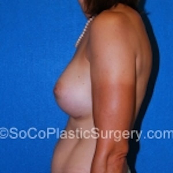 Breast Augmentation Before & After Gallery - Patient 7809585 - Image 4