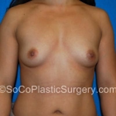 Breast Augmentation Before & After Gallery - Patient 7809588 - Image 1