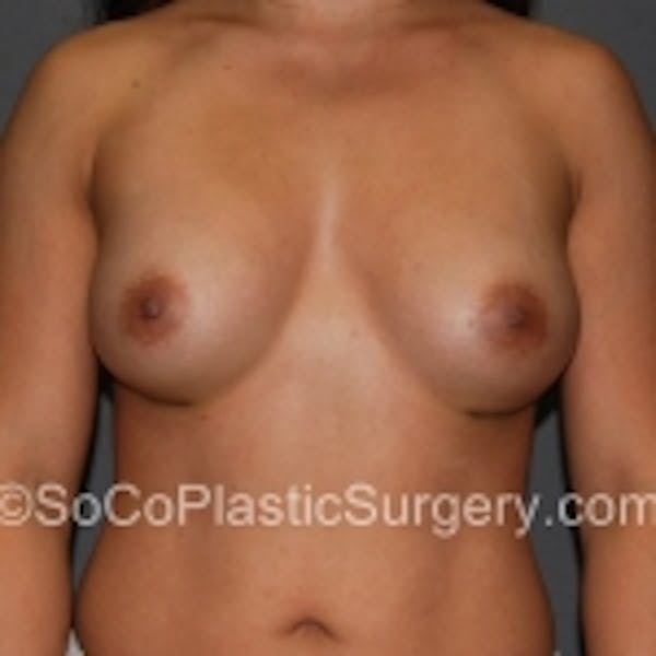 Breast Augmentation Before & After Gallery - Patient 7809588 - Image 2