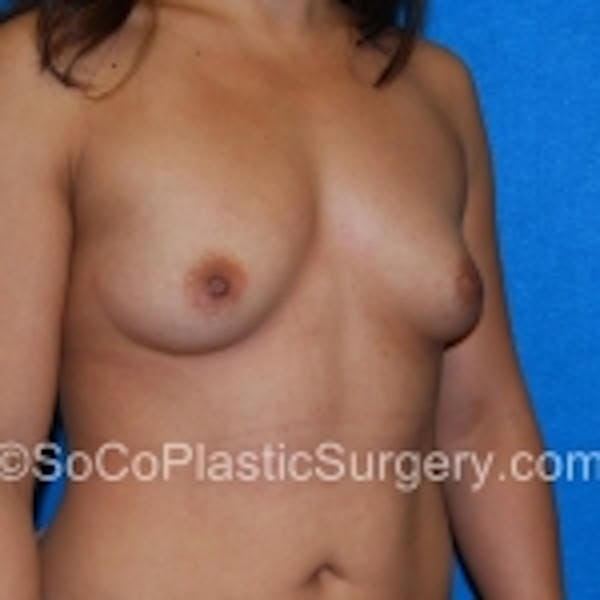 Breast Augmentation Before & After Gallery - Patient 7809588 - Image 3