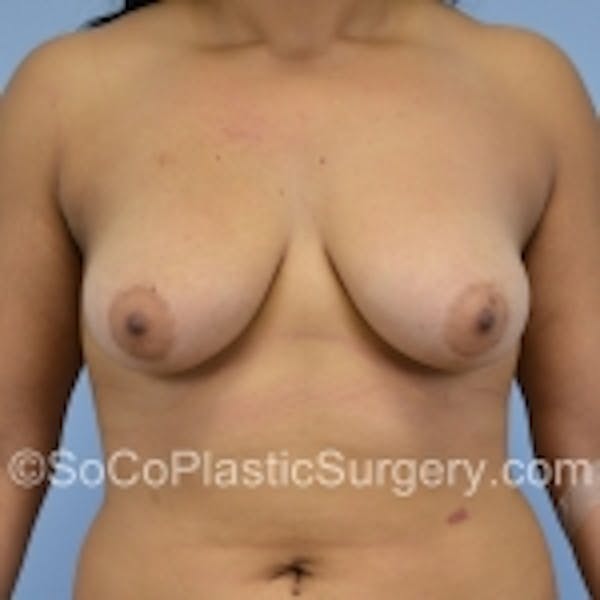 Breast Augmentation Before & After Gallery - Patient 7809590 - Image 1