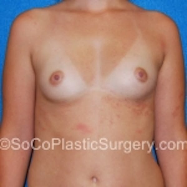 Breast Augmentation Before & After Gallery - Patient 7809595 - Image 1