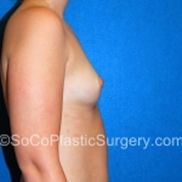 Breast Augmentation Before & After Gallery - Patient 7809595 - Image 5