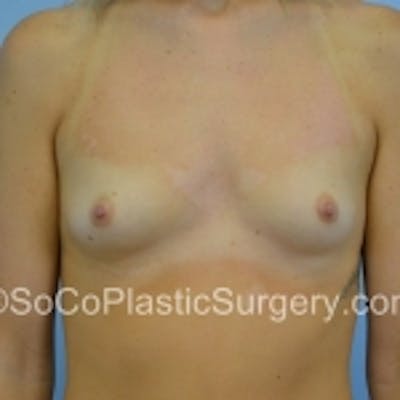 Breast Augmentation Before & After Gallery - Patient 7809596 - Image 1