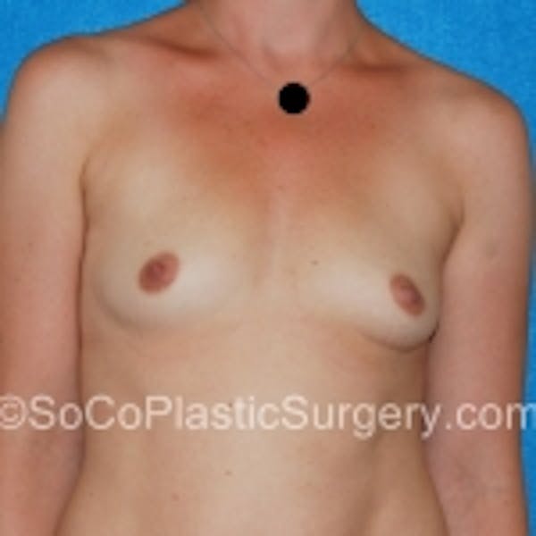 Breast Augmentation Before & After Gallery - Patient 7809598 - Image 1