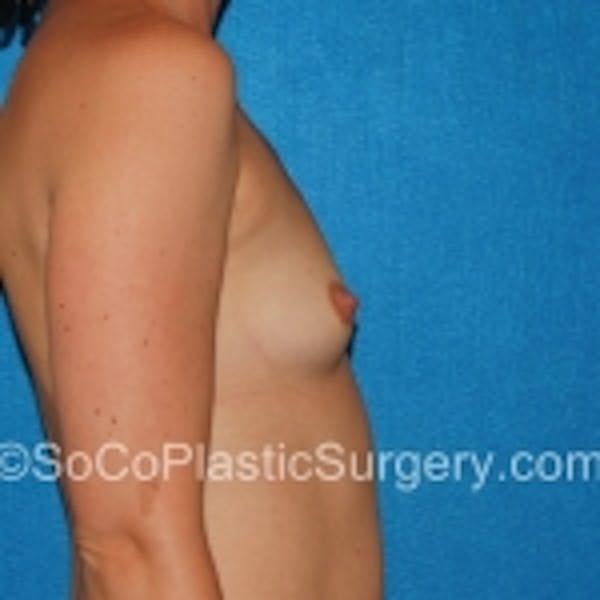 Breast Augmentation Before & After Gallery - Patient 7809598 - Image 5