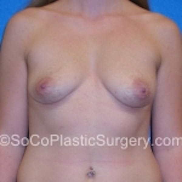 Breast Augmentation Before & After Gallery - Patient 7809607 - Image 1