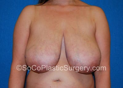 Breast Lift Before & After Gallery - Patient 8281894 - Image 1