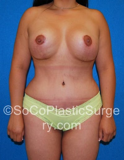 Mommy Makeover Before & After Gallery - Patient 8286134 - Image 2