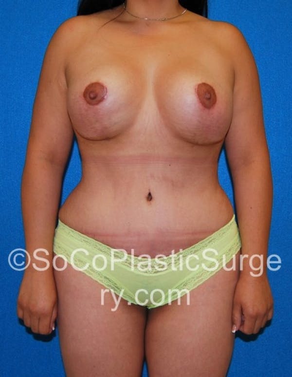 Mommy Makeover Gallery - Patient 8286134 - Image 2