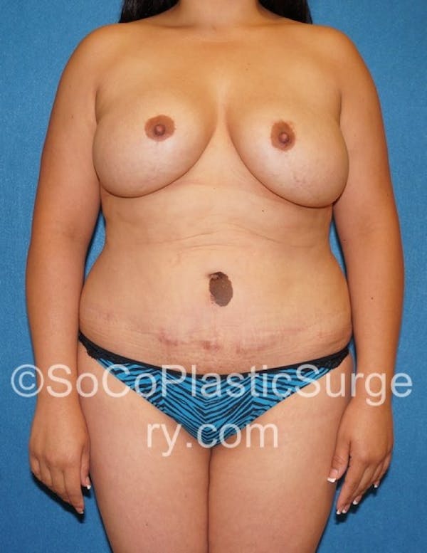Mommy Makeover Gallery - Patient 8286134 - Image 1