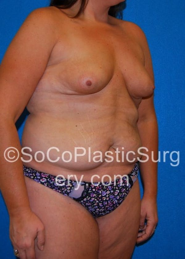 Mommy Makeover Before & After Gallery - Patient 8286136 - Image 5