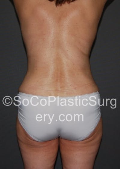 Tummy Tuck Before & After Gallery - Patient 8286183 - Image 2