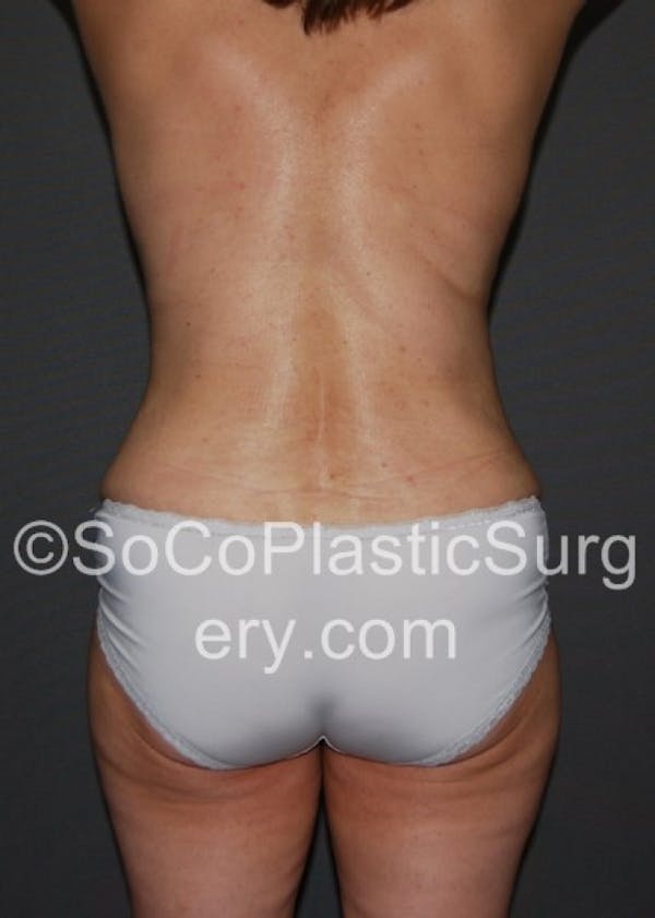 Tummy Tuck Gallery - Patient 8286183 - Image 2