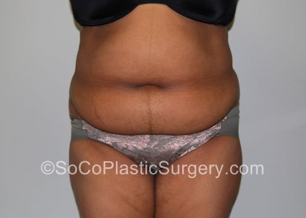 Tummy Tuck Before & After Gallery - Patient 8286184 - Image 1