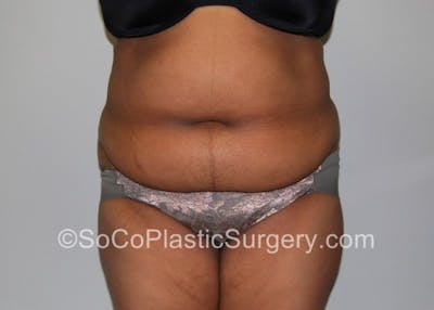 Tummy Tuck Before & After Gallery - Patient 8286184 - Image 1
