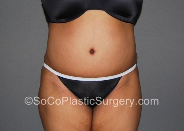Tummy Tuck Before & After Gallery - Patient 8286184 - Image 2