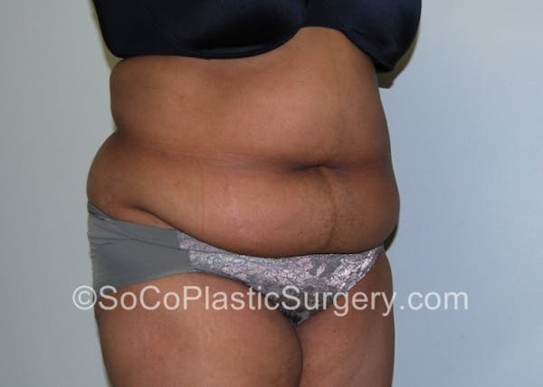 Tummy Tuck Gallery - Patient 8286184 - Image 3